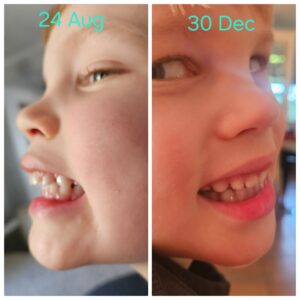 Little boy showing the different in his teeth since giving up thumb sucking