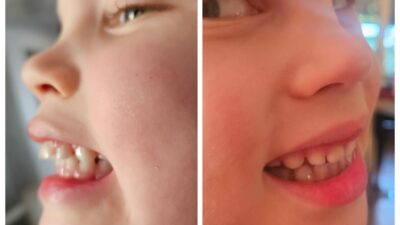 Little boy showing the different in his teeth since giving up thumb sucking