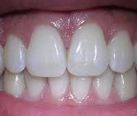 Picture of overbite